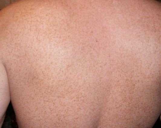 Sample of Freckled