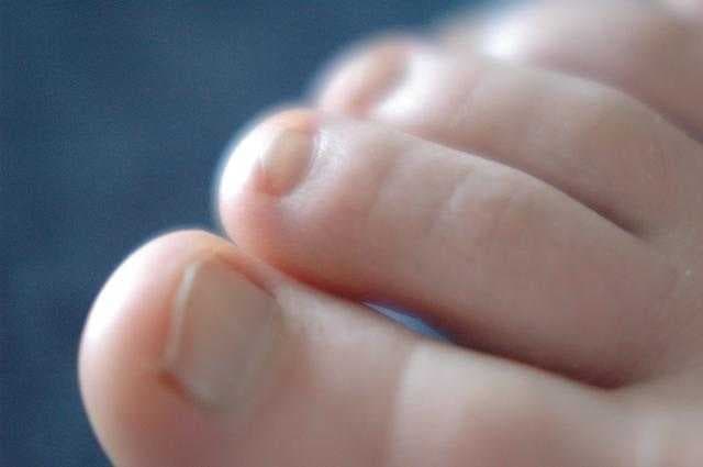 Sample of Toe