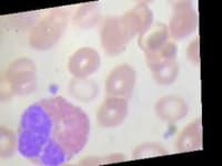 Sample 1 – Eosinophil