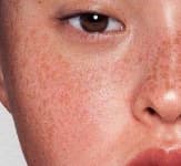 Sample 1 – Freckled