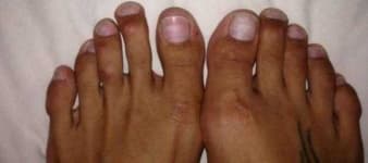 Sample 3 – Toe