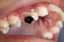 Sample 3 – Tooth