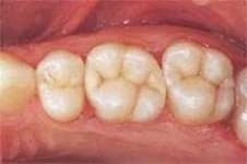 Sample 4 – Tooth