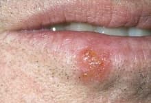 Sample 5 – Mouth