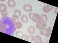 Sample 3 – Eosinophil