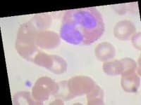 Sample 5 – Eosinophil