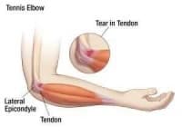 Sample 4 – Elbow