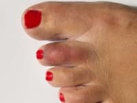 Sample 2 – Toe