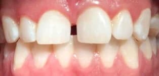 Sample 6 – Tooth