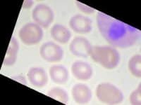 Sample 6 – Eosinophil