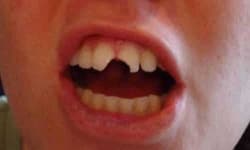 Sample 5 – Tooth