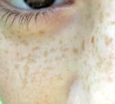 Sample 3 – Freckled