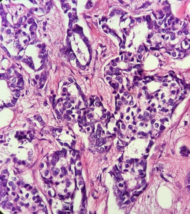 image of idc_breast_cancer_grading #0